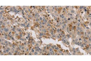 Immunohistochemistry of paraffin-embedded Human liver cancer tissue using KIF17 Polyclonal Antibody at dilution 1:40 (KIF17 anticorps)