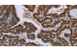 Immunohistochemistry of paraffin-embedded Human gastric cancer tissue using MYCN Polyclonal Antibody at dilution 1:35 (MYCN anticorps)