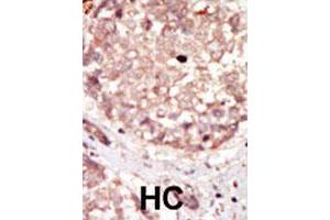 Formalin-fixed and paraffin-embedded human hepatocellular carcinoma tissue reacted with HIPK3 polyclonal antibody  , which was peroxidase-conjugated to the secondary antibody, followed by DAB staining. (HIPK3 anticorps)