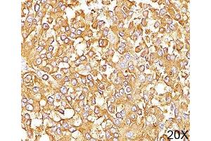 IHC staining of human melanoma (20X) with gp100 antibody (HMB45). (Melanoma gp100 anticorps)