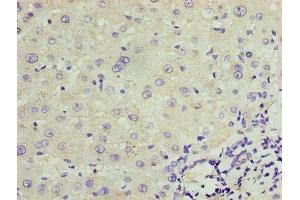 Immunohistochemistry of paraffin-embedded human liver cancer using ABIN7172859 at dilution of 1:100