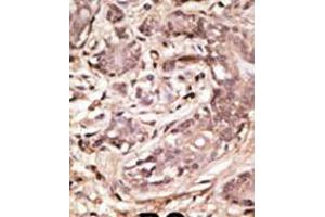 Formalin-fixed and paraffin-embedded human cancer tissue reacted with the primary antibody, which was peroxidase-conjugated to the secondary antibody, followed by AEC staining. (SUMO4 anticorps  (AA 34-63))