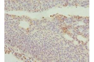 Immunohistochemistry of paraffin-embedded human bladder cancer using ABIN7150145 at dilution of 1:100 (DRAM2 anticorps  (AA 182-266))