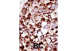 Formalin-fixed and paraffin-embedded human cancer tissue reacted with PIGK polyclonal antibody  , which was peroxidase-conjugated to the secondary antibody, followed by DAB staining . (PIGK anticorps  (C-Term))