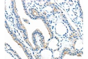 The image on the left is immunohistochemistry of paraffin-embedded Human thyroid cancer tissue using ABIN7189804(ANGPTL5 Antibody) at dilution 1/25, on the right is treated with synthetic peptide. (ANGPTL5 anticorps)