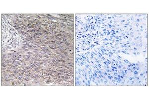Immunohistochemistry analysis of paraffin-embedded human cervix carcinoma tissue using CHSS2 antibody. (CHPF anticorps  (C-Term))