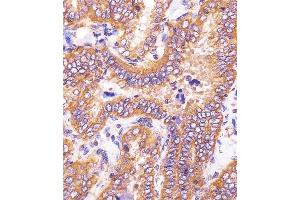 (ABIN6243230 and ABIN6578764) staining HSD17B10 in human thyroid carcinoma sections by Immunohistochemistry (IHC-P - paraformaldehyde-fixed, paraffin-embedded sections). (HSD17B10 anticorps  (AA 140-172))