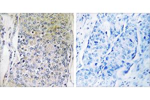 Peptide - +Immunohistochemistry analysis of paraffin-embedded human breast carcinoma tissue using CPXM2 antibody. (CPXM2 anticorps)