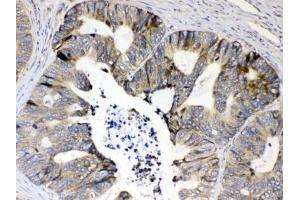 IHC testing of FFPE human intestinal cancer tissue with RPS6 antibody at 1ug/ml.