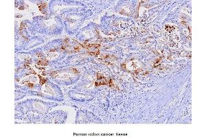 Paraffin embedded sections of human colon canitrocelluloseer tissue were initrocelluloseubated with anti-human FABP1 (1:100) for 2 hours at room temperature.