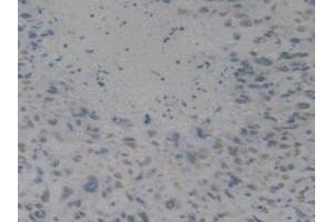 IHC-P analysis of Human Lung Cancer Tissue, with DAB staining. (HMGB1 anticorps  (AA 9-163))