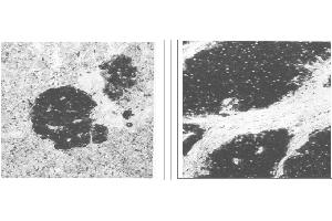 Immunohistochemical staining of normal pancreas tissue (left) and small bowel tumor tissue (center) using NSE antibody (X2070M and X2071M). (Enolase anticorps)