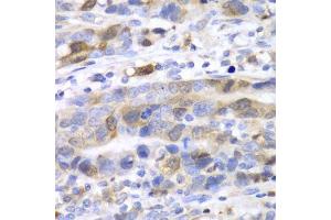 Immunohistochemistry of paraffin-embedded human gastric cancer using UBE2C antibody.