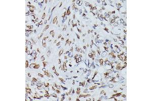 Immunohistochemistry of paraffin-embedded human oophoroma using Lamin B1 antibody (ABIN1513160, ABIN3023296 and ABIN3023297) at dilution of 1:100 (40x lens). (Lamin B1 anticorps)