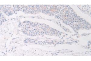 Detection of FLII in Human Prostate cancer Tissue using Polyclonal Antibody to Flightless I Homolog (FLII)