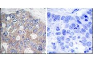 Immunohistochemistry analysis of paraffin-embedded human breast carcinoma tissue, using p70 S6 Kinase (Ab-421) Antibody. (RPS6KB1 anticorps  (AA 411-460))