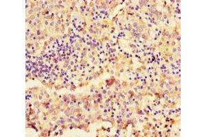 Immunohistochemistry of paraffin-embedded human lung cancer using ABIN7161043 at dilution of 1:100 (NAPSA anticorps  (AA 64-420))