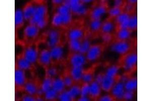 Immunofluorescence analysis of Human liver cancer tissue using Cleaved-CASP3 p12 (D175) Polyclonal Antibody at dilution of 1:200.