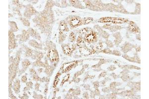 IHC-P Image Immunohistochemical analysis of paraffin-embedded human breast cancer, using Factor XI, antibody at 1:250 dilution.