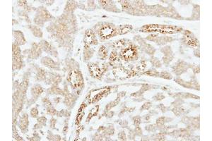 IHC-P Image Immunohistochemical analysis of paraffin-embedded human breast cancer, using Factor XI, antibody at 1:250 dilution. (Factor XI anticorps)