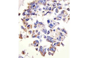 (ABIN1882228 and ABIN2843486) staining CTSD in human lung adenocarcinoma tissue sections by Immunohistochemistry (IHC-P - paraformaldehyde-fixed, paraffin-embedded sections). (Cathepsin D anticorps)