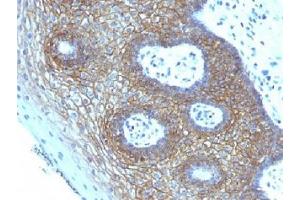 IHC testing of FFPE human cervical squamos cell carcinoma with CD44v4 antibody (clone CD44v4/1219). (CD44v4 anticorps)