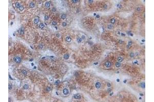 Detection of AKAP11 in Human Liver cancer Tissue using Polyclonal Antibody to A Kinase Anchor Protein 11 (AKAP11)