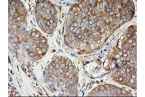 Immunohistochemical staining of paraffin-embedded Adenocarcinoma of Human breast tissue using anti-TUBB4 mouse monoclonal antibody. (TUBB4 anticorps)
