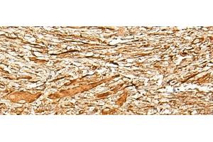 Immunohistochemistry of paraffin-embedded Human liver cancer tissue using ADGRF1 Polyclonal Antibody at dilution of 1:35(x200) (G Protein-Coupled Receptor 110 anticorps)