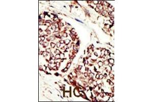 Formalin-fixed and paraffin-embedded human cancer tissue reacted with the primary antibody, which was peroxidase-conjugated to the secondary antibody, followed by DAB staining.
