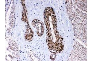 IHC testing of FFPE human lung cancer tissue with CPI-17 antibody at 1ug/ml. (CPI-17 anticorps)