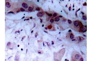 Immunohistochemistry with AP20955PU-N antibody in paraffin-embedded human breast carcinoma tissue. (JAK1 anticorps  (pTyr1022))