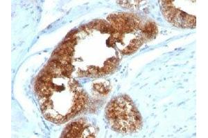 IHC staining of human prostate carcinoma with TAG-72 antibody cocktail (B72. (TAG-72 anticorps)