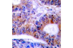 Immunohistochemical analysis of Cytokeratin 20 staining in human colon cancer formalin fixed paraffin embedded tissue section.