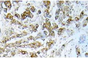 Immunohistochemistry (IHC) analyzes of HSP27 pAb in paraffin-embedded human breast carcinoma tissue. (HSP27 anticorps)