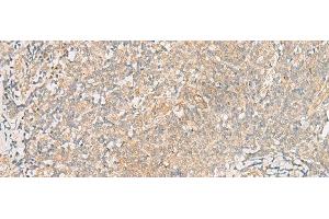 Immunohistochemistry of paraffin-embedded Human tonsil tissue using TRAF6 Polyclonal Antibody at dilution of 1:30(x200) (TRAF6 anticorps)