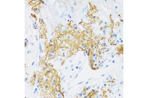 Immunohistochemistry of paraffin-embedded human lung cancer using ELN antibody (ABIN6291688) at dilution of 1:100 (40x lens). (Elastin anticorps)