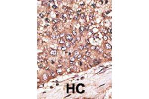 Formalin-fixed and paraffin-embedded human hepatocellular carcinoma tissue reacted with WISP1 polyclonal antibody  , which was peroxidase-conjugated to the secondary antibody, followed by DAB staining.