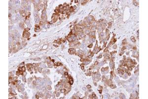 IHC-P Image Immunohistochemical analysis of paraffin-embedded OVCAR3 xenograft , using CBS, antibody at 1:500 dilution.