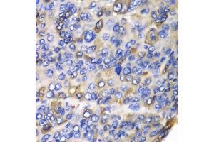 Immunohistochemistry of paraffin-embedded human liver cancer using CES1 antibody (ABIN5970951) at dilution of 1/100 (40x lens).