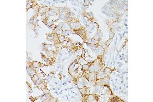 Immunohistochemistry of paraffin-embedded Human lung adenocarcinoma using PD-L1/CD274/CD274 Rabbit mAb (ABIN7266181) at dilution of 1:200 (40x lens). (PD-L1 anticorps  (Extracellular Domain))