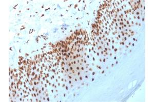 Formalin-fixed, paraffin-embedded human Basal Cell Carcinoma stained with Nucleophosmin Mouse Monoclonal Antibody (NPM1/3398). (NPM1 anticorps  (AA 185-287))