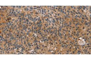 Immunohistochemistry of paraffin-embedded Human esophagus cancer tissue using TAC1 Polyclonal Antibody at dilution 1:25 (TAC1 anticorps)