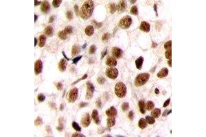 Immunohistochemical analysis of C/EBP zeta staining in human breast cancer formalin fixed paraffin embedded tissue section. (DDIT3 anticorps  (N-Term))