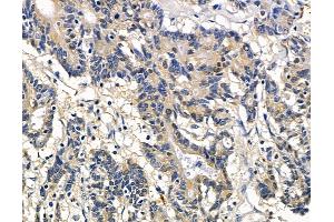 ABIN7097056 and ABIN7101123 at 1/100 staining human colorectal cancer and adjacent non-tumor tissue by IHC-P. (NHLRC2 anticorps)