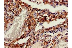 Immunohistochemistry of paraffin-embedded human lung cancer using ABIN7146203 at dilution of 1:100