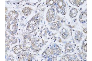 Immunohistochemistry of paraffin-embedded human breast cancer using BRCA1 antibody. (BRCA1 anticorps  (AA 120-220))