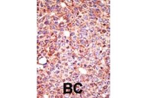Formalin-fixed and paraffin-embedded human cancer tissue reacted with the primary antibody, which was peroxidase-conjugated to the secondary antibody, followed by AEC staining.