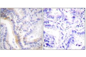 Immunohistochemistry analysis of paraffin-embedded human lung carcinoma tissue, using urocortin antibody. (Urocortin anticorps  (C-Term))