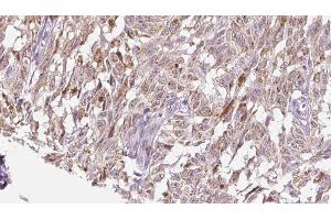 ABIN6276527 at 1/100 staining Human Melanoma tissue by IHC-P. (CRH anticorps  (N-Term))